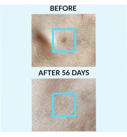 Pigment Controle - Patch 2 - (Sol & Age-stenden) - Talika