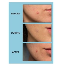 Patch de peau libre - 25 patch - Talika