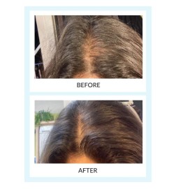 Haarwaffe Serum & Booster-LED-Kit - Talika